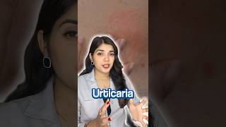 How I Cured My Urticaria Chronic Hives  My Story [upl. by Ansilme]