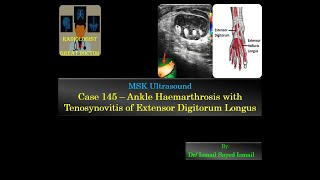 Ultrasound Case 145  Ankle Haemarthrosis amp EDL Tenosynovitis [upl. by Ahsielat]