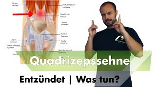 Quadrizepssehnenentzündung  Ursache amp Speziallösung [upl. by Berglund]