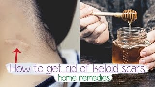 how to get rid of keloid scars Fast  Home remedy 💚 [upl. by Atteselrahc959]