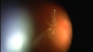 Eye Floater Laser Vitreolysis Patient of Scott Geller MD [upl. by Rodolph]