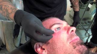 Rich Piana getting dermal implant removed [upl. by Heidie]