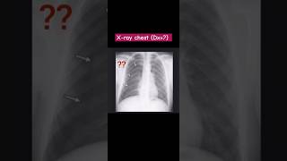 Xray Chest Pneumothoraxradiology [upl. by Anilev]