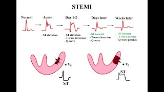 USMLE ACE Video 119 Coronary Artery Disease CAD and Congestive Heart Failure CHF [upl. by Jesse]