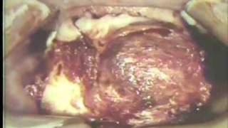 Removal of Large Ameloblastoma of Mandible [upl. by Jun]