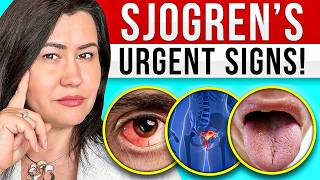 10 Signs of Sjogrens Syndrome  a very complex autoimmune disease [upl. by Rosmunda]