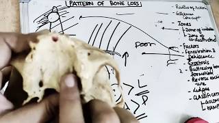 pattern of bone loss in periodontal disease [upl. by Parik]