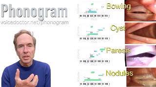 Phonogram  identifying a voice disorder [upl. by Eynenihc]