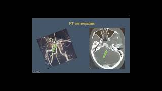 Retrosigmoid Craniotomy for Clipping of a Ruptured PICA Aneurysm [upl. by Deste]