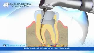 Dolor de muelas y dientes la corona por Clínica Dental Virgen del Pilar [upl. by Nivalc]