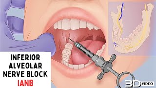 Inferior alveolar nerve block IANB [upl. by Duhl]