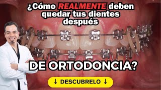 ¿Cómo realmente🧐 DEBEN QUEDAR TUS DIENTES DESPUÉS DE LA ORTODONCIA [upl. by Germayne408]