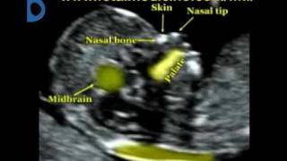 Fetal Medicine Foundation  Nuchal translucency [upl. by Cochrane]