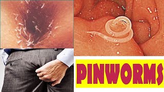 Enterobious Vermicularis Pin Worm Morphology  Eggs  Life cycle  Pathogenesis  Microbiology [upl. by Nirrek]