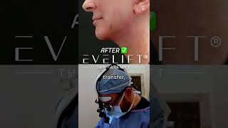 EVE Lift™ To Redefine The Jawline And Neck  Eden Plastic Surgery Dr Ali Charafeddine MD [upl. by Piegari205]