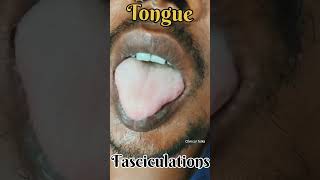 Tongue Fasciculations fasciculation snakebite neurotoxin clinicaltalks [upl. by Adiaros]