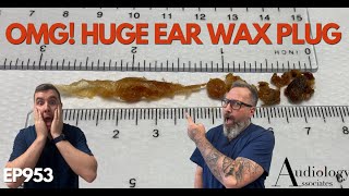 OMG HUGE EAR WAX PLUG REMOVED  EP953 [upl. by Anikram]