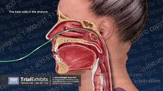 Complications of Nasogastric Tube Insertion [upl. by Yrreg950]