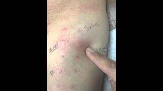 Final allergy skin test [upl. by Menedez757]