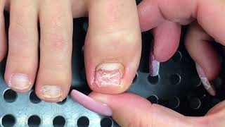 Toenail Reconstruction with NanoFlex by Fuzion [upl. by Marney]