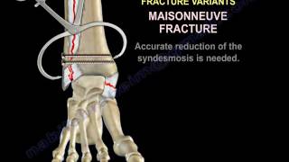 Ankle Fractures  Special Situations  Everything You Need To Know  Dr Nabil Ebraheim [upl. by Acemat]