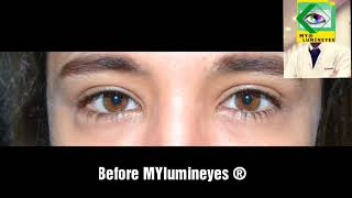 Laser Eye Color Change Surgery Procedure brown to amazing blue eyes [upl. by Yee]