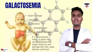 WHAT IS GALACTOSEMIA   CLINICAL ASPECTS  DIAGNOSIS  ENZYME DEFICIENT  TREATMENT [upl. by Aicinad]