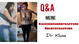 QampA Bauchdeckenstraffung Bruststraffung bei DR KLOSE [upl. by Attekal835]