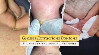 Extraction de gros points noirs et de boutons géants  Meilleures vidéos dextraction de boutons [upl. by Ytak]