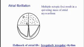 ECG Atrial Fibrillation [upl. by Cimbura]