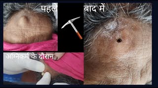 The Untold Secrets of Sebaceous Cyst Treatment himanshuarya5432 [upl. by Neirad669]