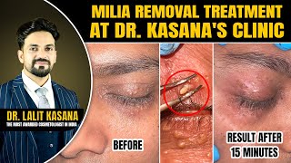 Milia Removal Treatment at DrKasanas Clinic [upl. by Auqinet141]