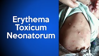 Erythema Toxicum Neonatorum [upl. by Bone]