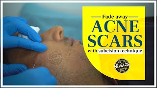 Subcision Treatment for Acne Scars  Acne Scars Treatment [upl. by Tamaru717]