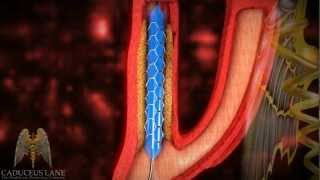 3D Medical Video HD  Carotid Artery Stenting [upl. by Daryle779]