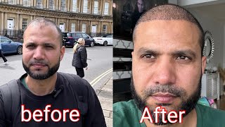 REMOVE SCABS DAY 2 Weeks After HairTransplant [upl. by Lleksah]