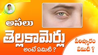 Jaundice  Symptoms Causes amp Treatment  Manthena Satyanarayana Raju Videos [upl. by Idurt]