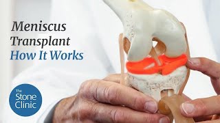 Meniscus Replacement  How it Works amp What to Expect [upl. by Haeluj24]