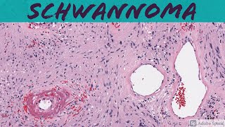 Schwannoma Neurilemoma  Histopatholgy [upl. by Nylear946]