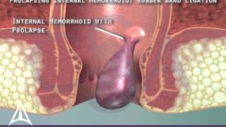 Rubber Band Ligation for Hemorrhoids  3D Medical Animation [upl. by Yesima]