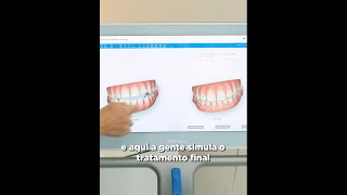 Aparelho Ortodôntico Invisalign  Dra Caroline Bianchi [upl. by Ahseenat867]