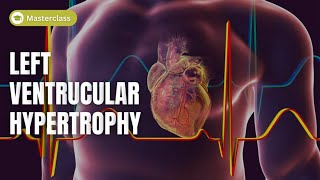 Masterclass on Left Ventricular Hypertrophy LVH and ECG Criteria clinical Essentials [upl. by Moscow]