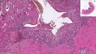 Crohns Disease  Histopathology [upl. by Aicxela]