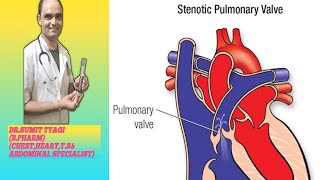 PULMPNARY STENOSIS VALVE BY DRSUMIT TYAGISUMITMEDICALDISPENSARY1 [upl. by Giacinta822]