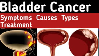 Bladder Cancer Types What causes bladder cancer Bladder Cancer Symptoms Bladder Cancer Treatment [upl. by Loree]