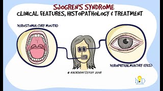 Sjogrens syndrome Part 2  Clinical features and Histopathology [upl. by Neal412]