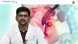 Manipal Hospital Vijayawada  All About Colonoscopy  Dr Rajesh Chandra [upl. by Mackenie771]