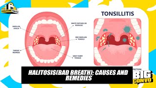 Halitosis Causes Effects And It’s Treatment [upl. by Tarfe999]