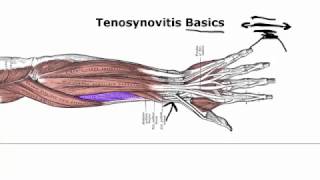 Tenosynovitis Basics Your Doctor Doesnt Tell You [upl. by Haroun]