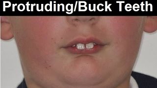 What Causes Protruded Teeth Buck Teeth Frontal Teeth Tipping Forward by Dr Mike Mew [upl. by Iseabal]